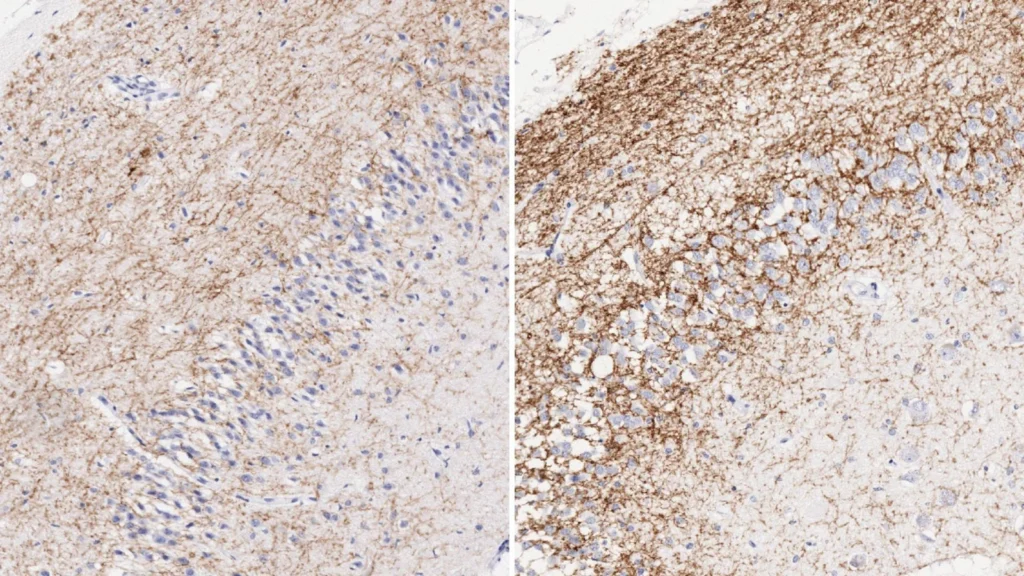 “Comparativa del hipocampo en personas sin síndrome de Down y con síndrome de Down, mostrando niveles elevados del receptor CB1R.